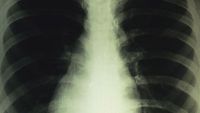 Respiratory System-Anatomy of the Lungs
